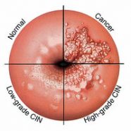 HPV high in men